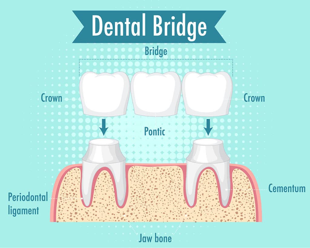 Dental bridge