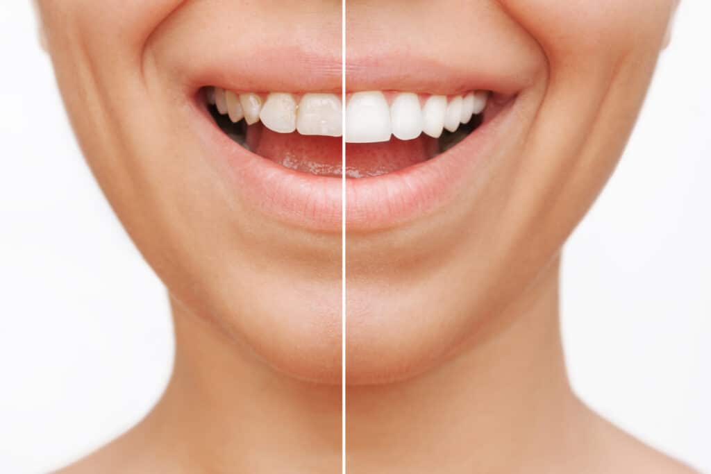 Before and after smile