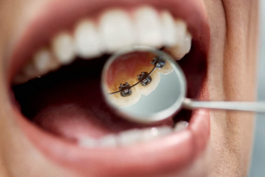 Close-up of female patient having check-up of dental braces on the back side of her teeth at dental clinic.